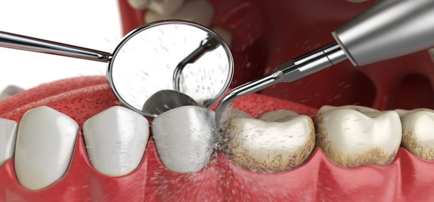 профессиональная чистка зубов
